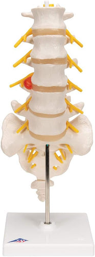 Columna vertebral lumbar A76/5 con disco intervertebral prolapsado dorso-Lateral, altura de 13.4
