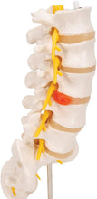 Cargar imagen en el visor de la galería, Columna vertebral lumbar A76/5 con disco intervertebral prolapsado dorso-Lateral, altura de 13.4&quot;