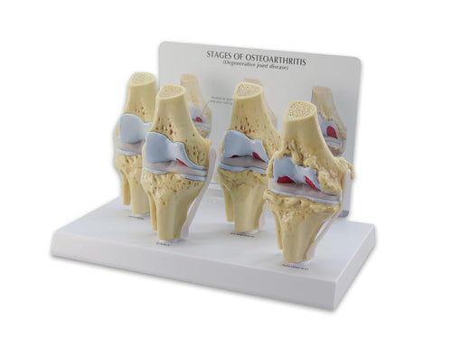 Juego de rodilla 3/4 tamaño de artrosis conjunto de 4 modelos anatómicos