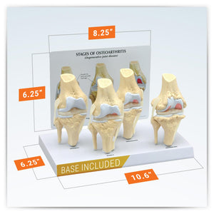 Juego de rodilla 3/4 tamaño de artrosis conjunto de 4 modelos anatómicos
