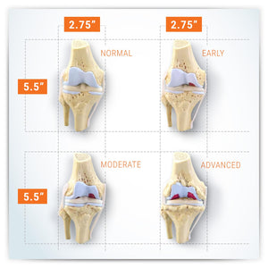 Juego de rodilla 3/4 tamaño de artrosis conjunto de 4 modelos anatómicos