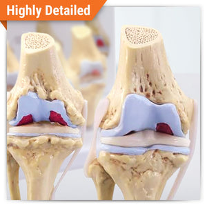 Juego de rodilla 3/4 tamaño de artrosis conjunto de 4 modelos anatómicos