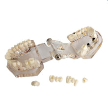 Cargar imagen en el visor de la galería, Modelo de implante dental y reparación neutra para demostraciones de enseñanza de dentistas.