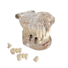 Cargar imagen en el visor de la galería, Modelo de implante dental y reparación neutra para demostraciones de enseñanza de dentistas.