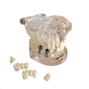 Modelo de implante dental y reparación neutra para demostraciones de enseñanza de dentistas.
